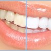 $399 August Whitening Special