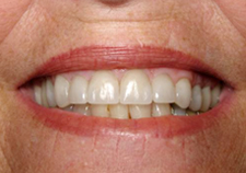 Dental Implants After Picture