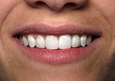 Veneers After Picture